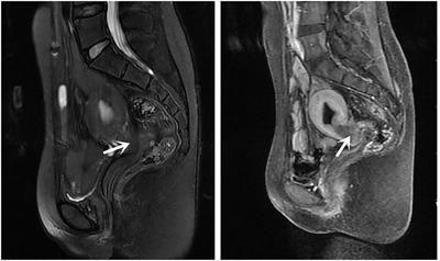 Cervical and endometrial cancers of intestinal origin diagnosed 18 years after vaginal replacement with a sigmoid colon segment: a case report and review of the literature